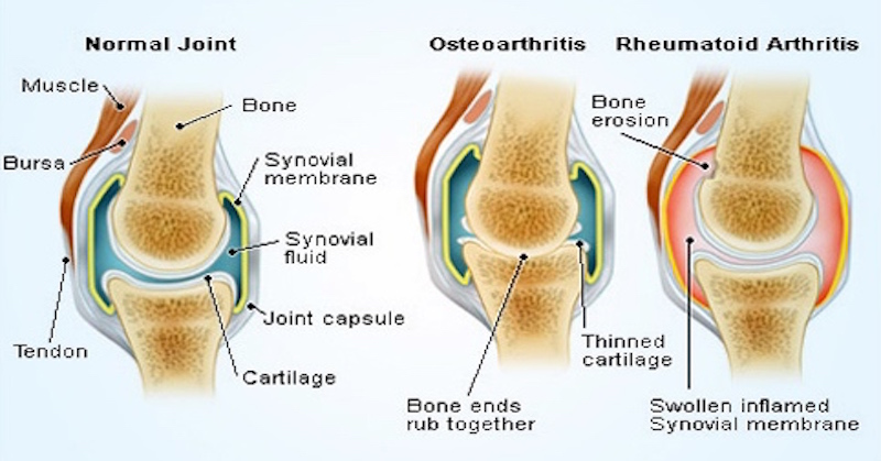 arthritis prevention