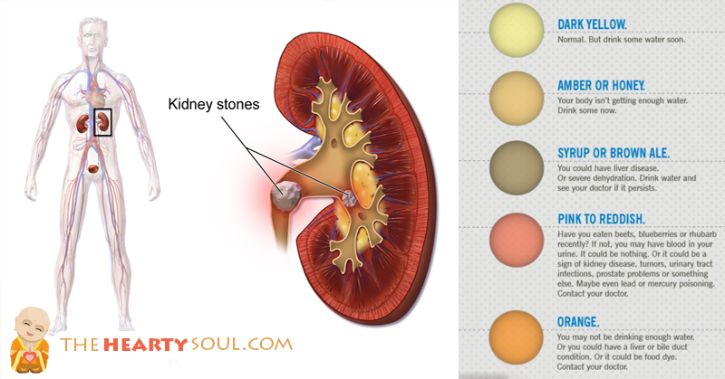 fmc woodbury dialysis kidney transplant timeline