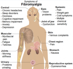 Symptômes de la fibromyalgie