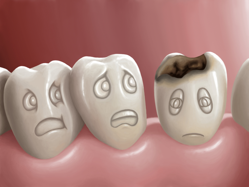 Tooth decay