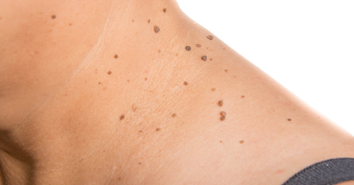 moles