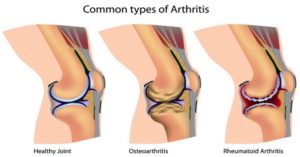 How an Anti-Inflammatory Diet Could Help With Arthritis Flair-Ups Common types of arthritis