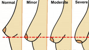 5 Myths About Sagging Breasts and 4 Ways to Stop it From Happening to You SAGGING-BREASTS