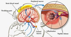 The Link Between Your Serotonin and Headaches and Migraines link between serotonin and migraines