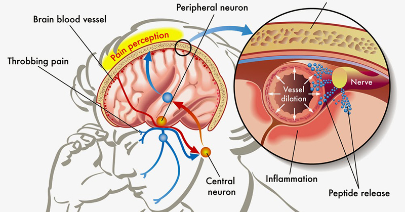 link between serotonin and migraines