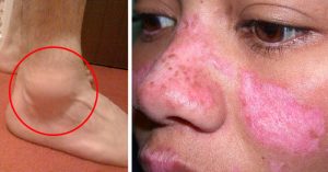 Lupus Symptoms: 13 Ways to Spot Lupus Disease Early lupus symptoms