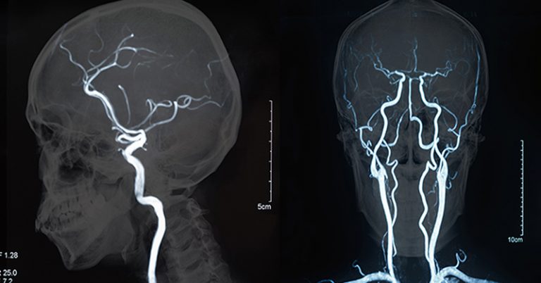 7 Deadly and Often Unnoticed Signs of a Stroke - Featured image