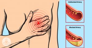 illustration woman holding chest, radiating bulls eye. Heart disease, arterial health, clogged arteries concept