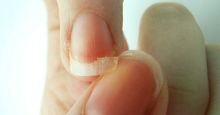 Brittle Nails? Poor Sleep? Start Eating More Of These Foods Immediately - Featured image