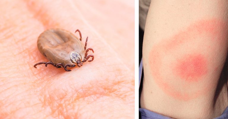 5 Ways to Make Sure You Don’t Get Lyme Disease This Summer - Featured image