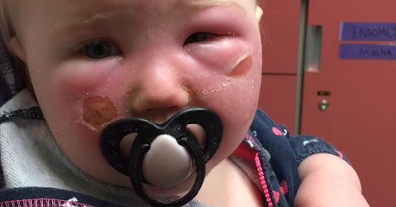 Baby with severe sunburn on the face
