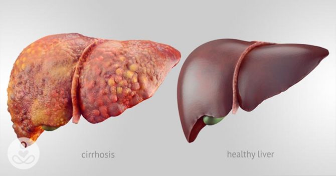 poor liver health liver-health