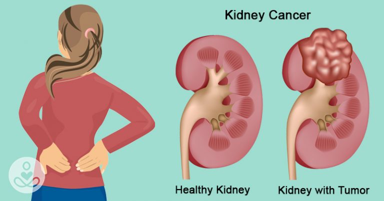 7 early warning signs that cancer is growing inside your kidneys - Featured image