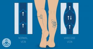 3 science-backed tips you should know to get rid of varicose veins on your legs THS Reframes_Mar 6_science-backed tips you should know to get rid of spider veins on your legs