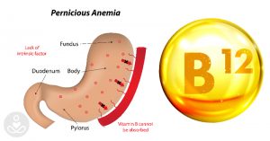 b12 deficiency