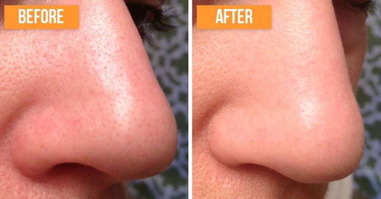 How to Get Rid of Blackheads Naturally (2-Ingredient Recipe) - Featured image