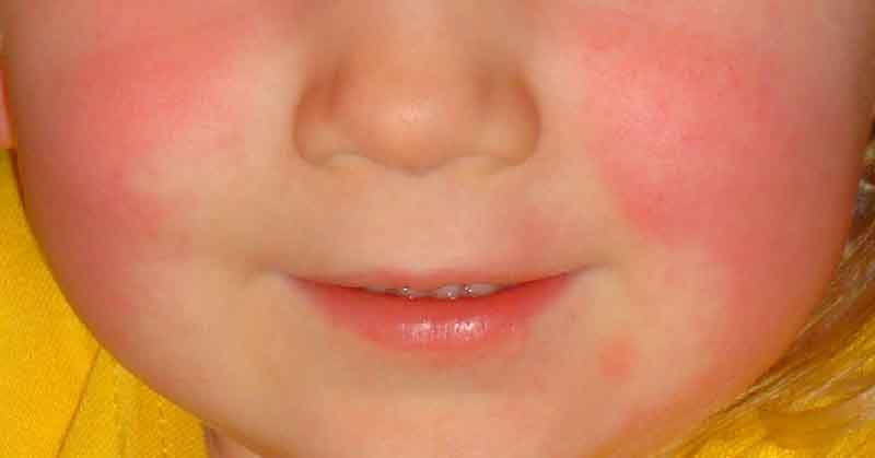 close up, boy with scarlet fever symptoms