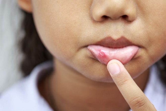 cold sores toddlers