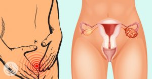 There’s One Way To Check For Ovarian Cancer That Nobody Talks About - Here’s Why ca125