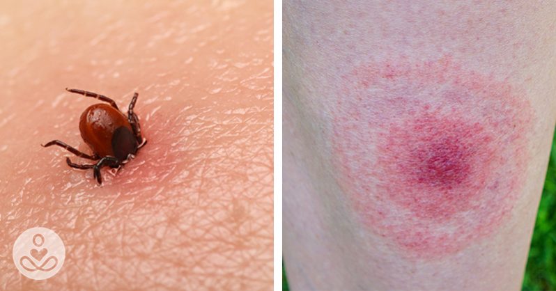 Lyme Disease is On The Rise: These are the Signs, Symptoms, and ...