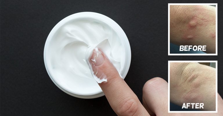 Rub This Peppermint and Baking Soda Mixture Anywhere You Need Relief From Mosquito and Bug Bites - Featured image