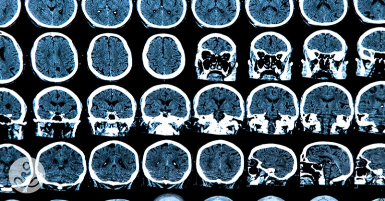 2 Drugs Identified That Could Halt The Progression Of ALL Neurodegenerative Diseases - Featured image