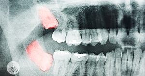 wisdom teeth removal