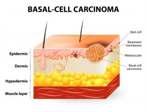 Basal Cell Carcinoma causes