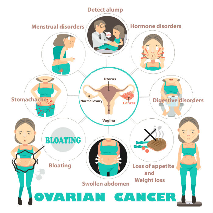 ovarian cancer symptoms, ca125