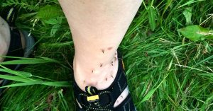 The Surprising Reasons Why Mosquitoes Bite Some People and Don’t Touch Others I persons angle covered in bugs and bug bites