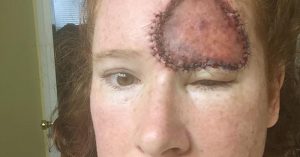 Mom Survives Rare Form of Melanoma, Warns to 'Stop Frying Your Skin' THS_July_17_Mon24_13_'Stop-frying-your-skin'--Mom-shares-harrowing-recovery-from-melanoma