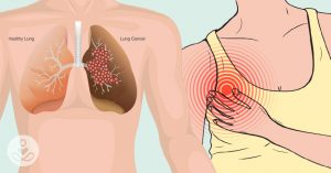 THS_Aug14_Part04_cont_01_12-Symptoms-of-Lung-Cancer-That-Everyone-Should-Know