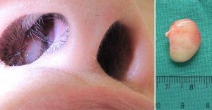 Nasal Polyps: Symptoms, Causes, and Treatments THS_Sep25_Part01_11_Tested_If-you-find-a-soft-fleshy-lump-inside-your-nose
