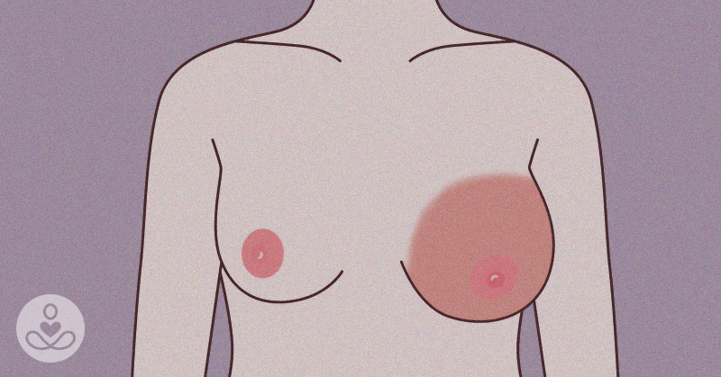 Early Signs of Breast Cancer concept