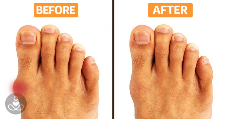 Don’t Let Bunions Control Your Life, Try This At-Home Bunion Treatment to Relieve Your Pain Today - Featured image
