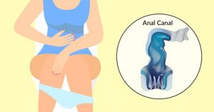 Anal-Cancer-798x418
