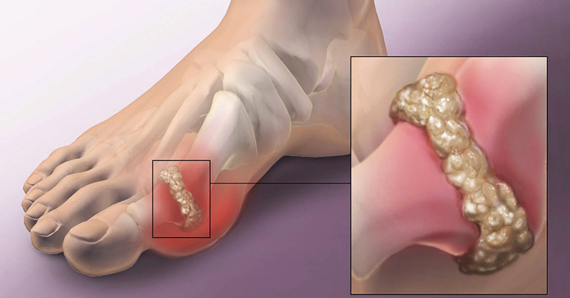 Illustration of foot with depiction of uric acid crystals forming in toes. Gout arthritis concept