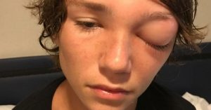 Orbital Cellulitis: How a Cruise Left a 15-Year-Old Blind in One Eye Jan29_Part01_08_golf-ball-eye
