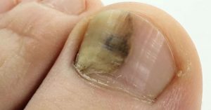 Nail Fungus: Symptoms, Treatment, and Home Remedies Feb05_Part01_07_nail-fungus