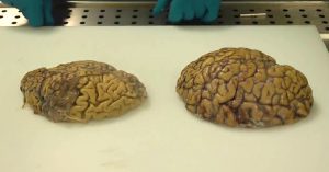 Feb12_Part05_01_root-cause-of-alzheimers