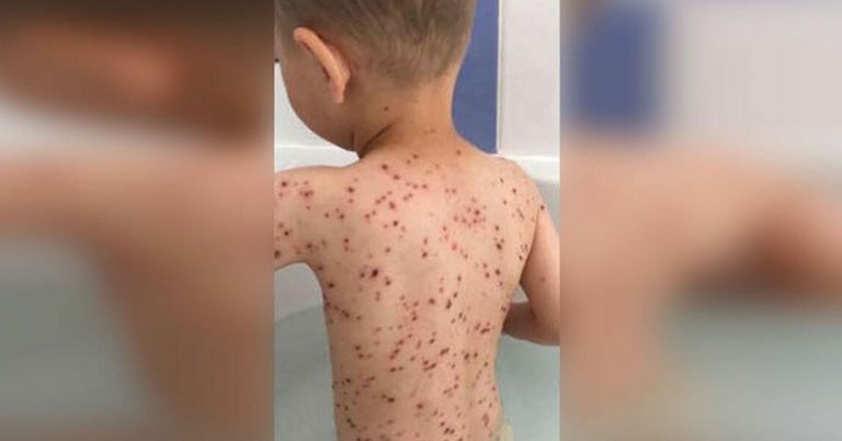 Mom's Facebook Post Serves as a Reminder Why Ibuprofen and Chickenpox