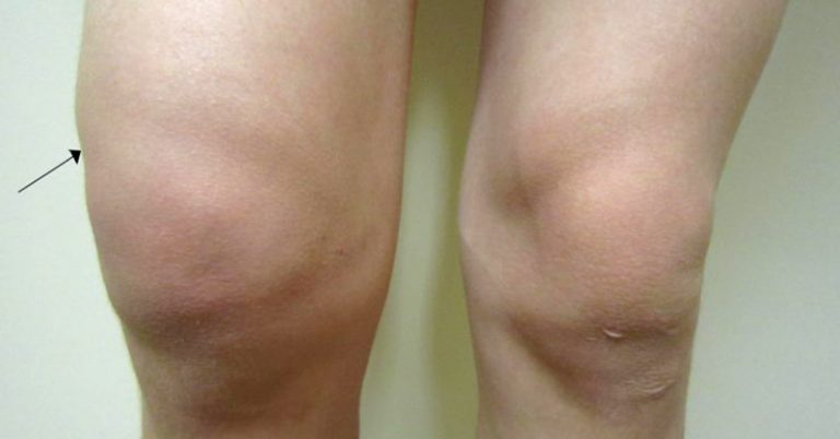 What is Fibromyalgia Swelling and What Causes it? - Featured image