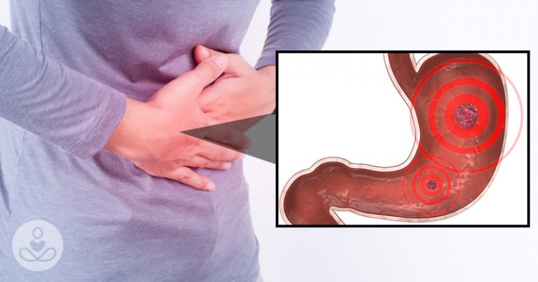 Early Symptoms of a Stomach Ulcer That Shouldn’t Be Ignored - Featured image