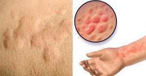 Cold Urticaria: Symptoms, Causes, and How to Treat Being Allergic to Cold