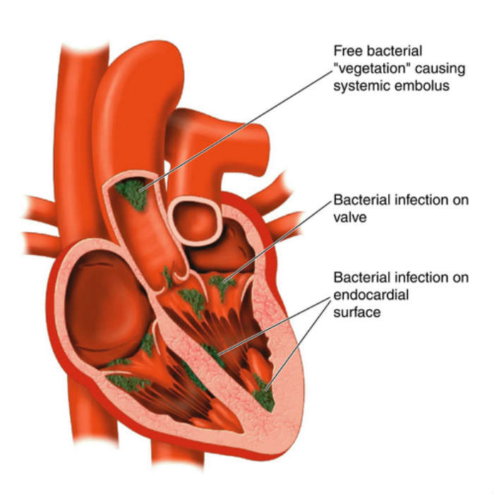 endocarditis symptoms