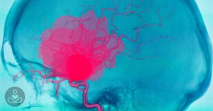 May21_Part03_04_brain-aneurysms