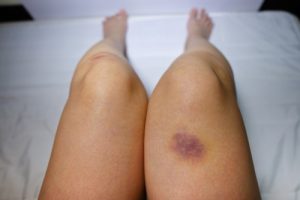 What causes bruising-a leg appears with a bruise on it