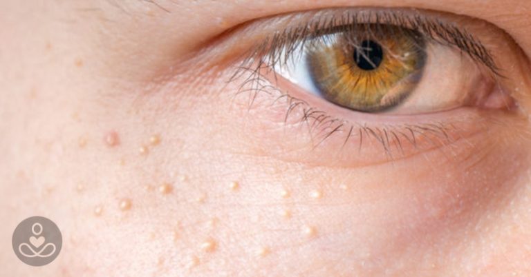 If You Have These Tiny, White B*mps on Your Face, Don’t Try to Remove Them!