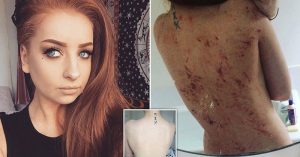 July16_Part02_02_Eczema-Woman
