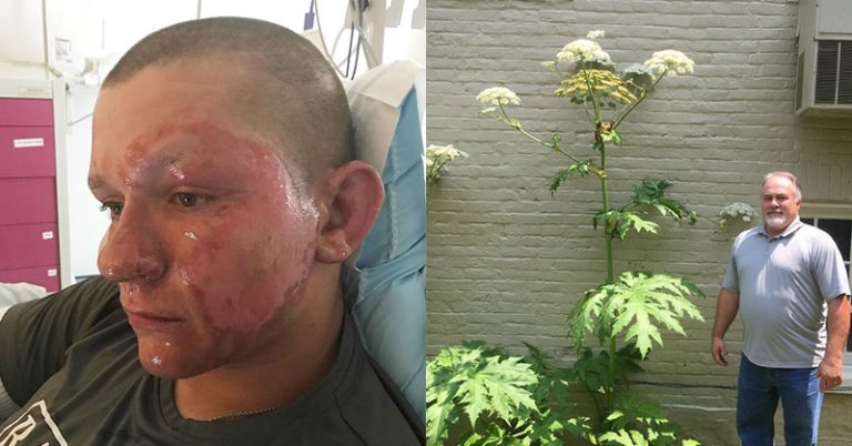 Teen Spends 2 Nights in Burn Unit After Run-In With Giant Hogweed Plant - Featured image